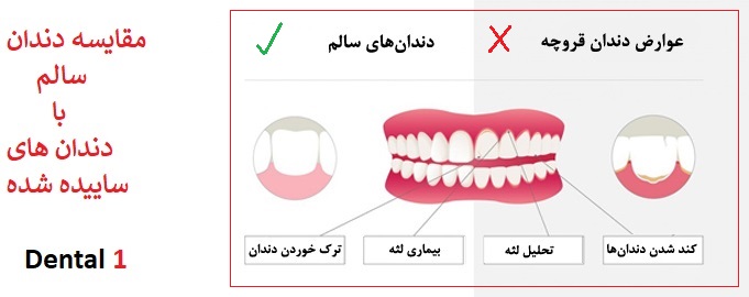 درمان ساییدگی مینای دندان