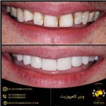 کامپوزیت دندان عکس قبل و بعد در مطب دندانپزشکی
