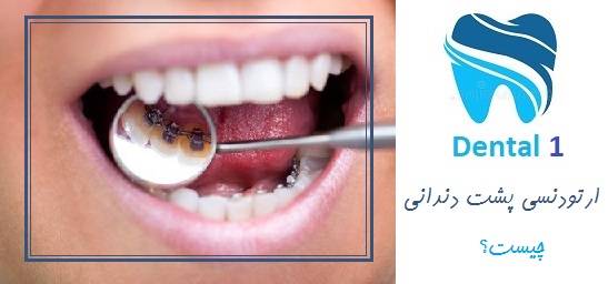 ارتودنسی پشت دندانی چیست؟