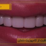 چگونگی مراقبت از کامپوزیت دندان