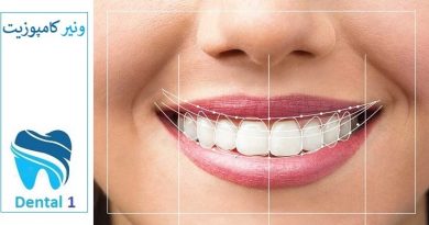 آیا کامپوزیت دندان درد دارد ؟