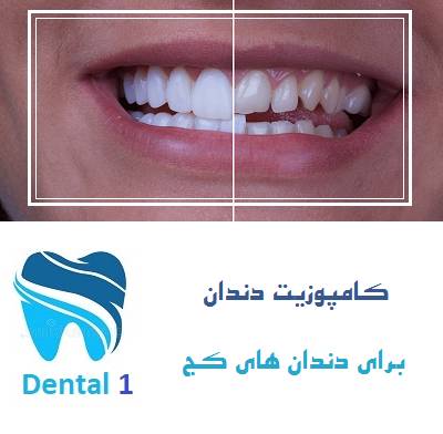 کامپوزیت دندان برای دندان های کج