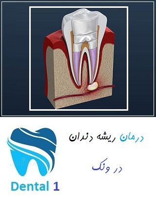 درمان ریشه دندان در ونک