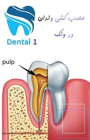 عصب کشی دندان در ونک