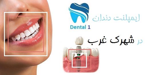 مزایا و عوارض ایمپلنت دندان در شهرک غرب