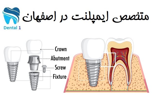 -ایمپلنت-در-اصفهان.jpg