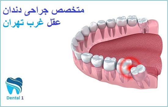 متخصص جراحی دندان عقل غرب تهران