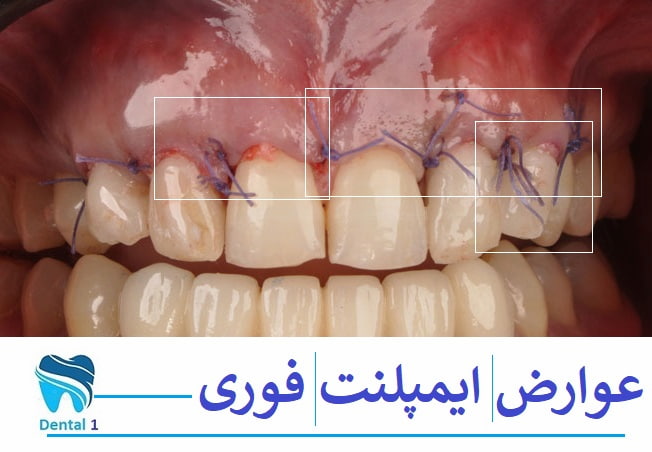 عوارض ایمپلنت فوری