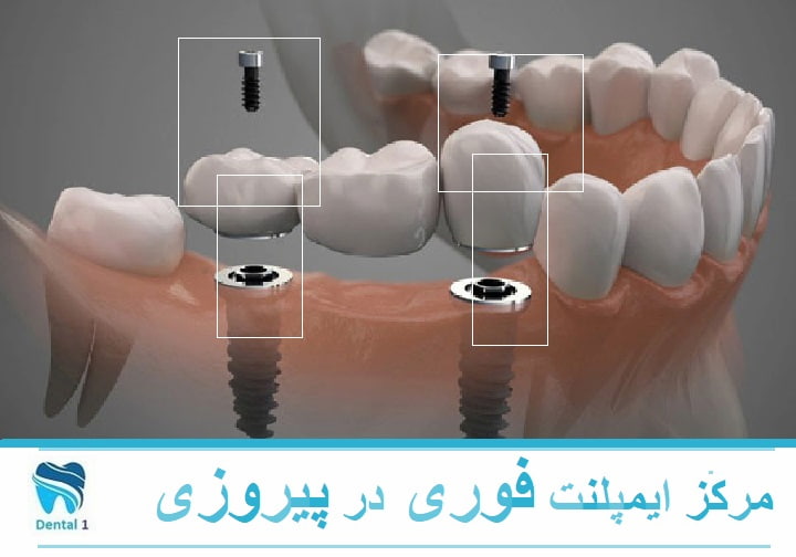 مرکز ایمپلنت فوری در پیروزی