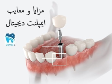 مزایا و معایب ایمپلنت دیجیتال