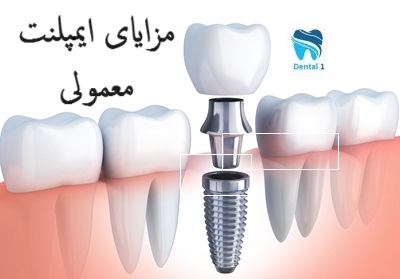 مزایای ایمپلنت معمولی