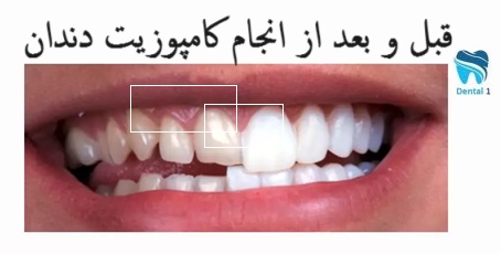 قبل و بعد از انجام کامپوزیت دندان