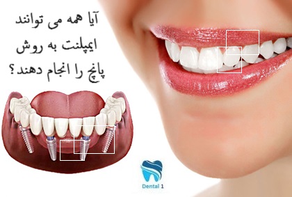 ایمپلنت به روش پانچ