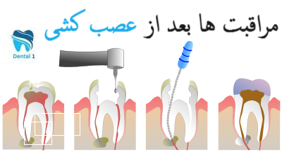 مراقبت ها بعد از عصب کشی دندان