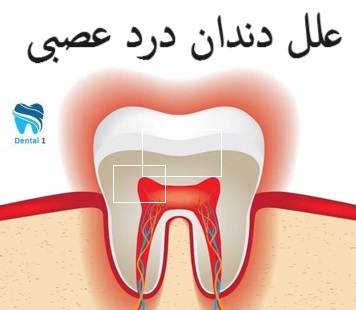 علل دندان درد عصبی