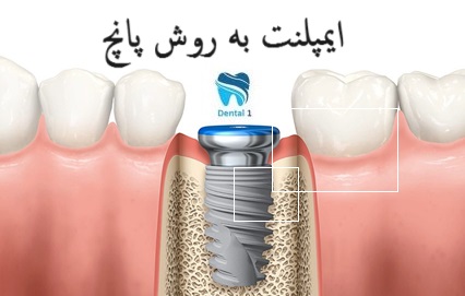 ایمپلنت به روش پانچ