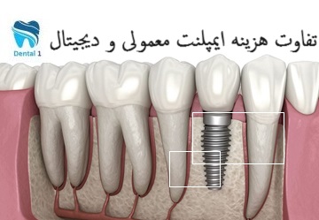 تفاوت هزینه ایمپلنت معمولی و دیجیتال