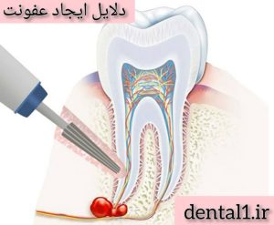 دلایل ایجاد عفونت