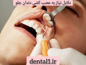 دلایل نیاز به عصب کشی دندان جلو