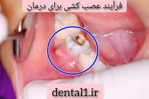 فرآیند عصب کشی برای درمان