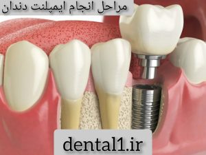 مراحل انجام ایمپلنت دندان