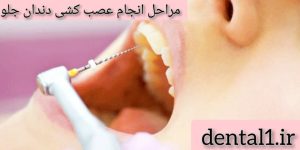 مراحل انجام عصب کشی دندان جلو