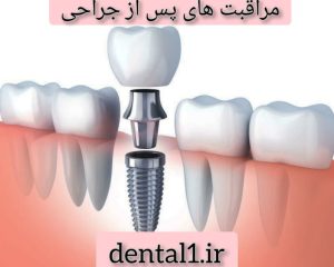 مراقبت های پس از جراحی