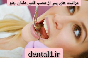 مراقبت های پس از عصب کشی دندان جلو